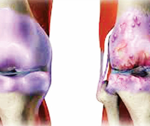 অস্টিও আর্থ্রাইটিস প্রতিরোধ করি